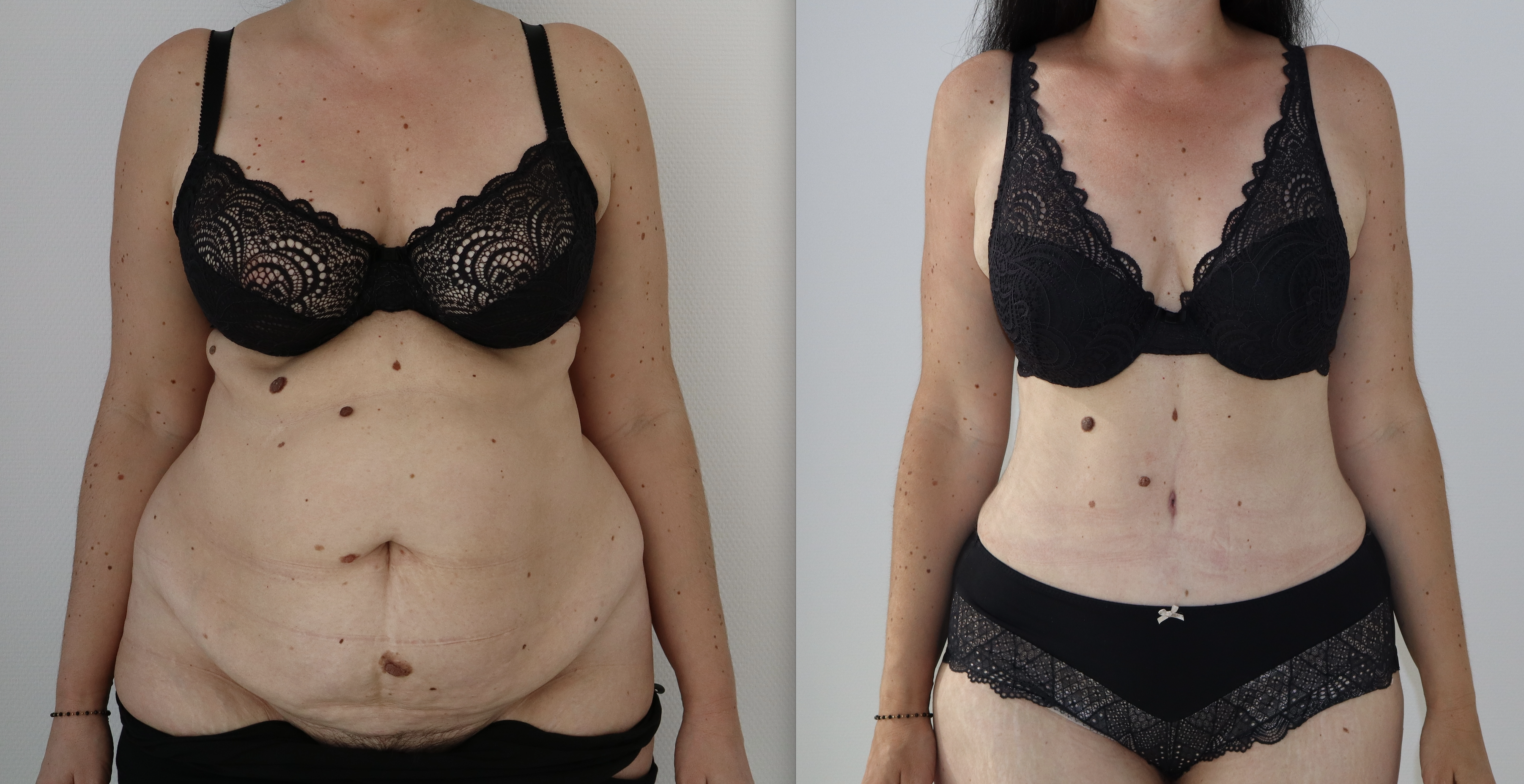 Avant/Après abdominoplastie