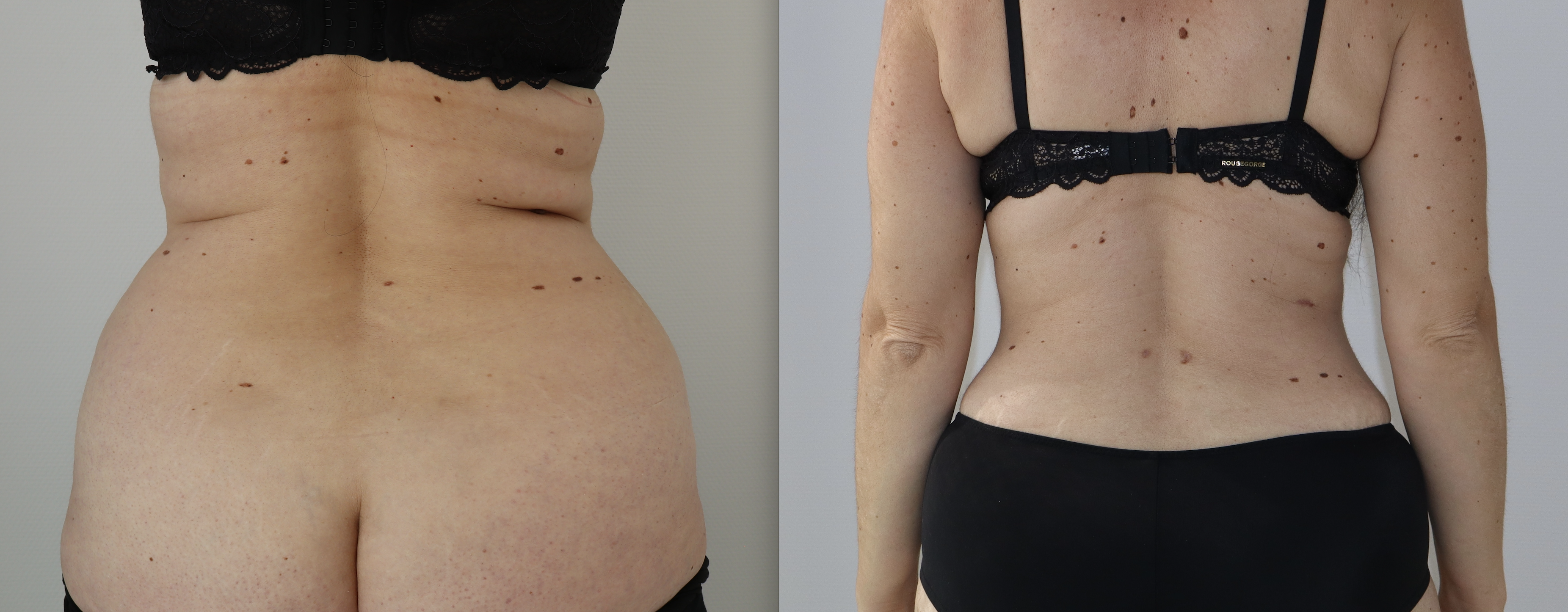 Avant/Après abdominoplastie
