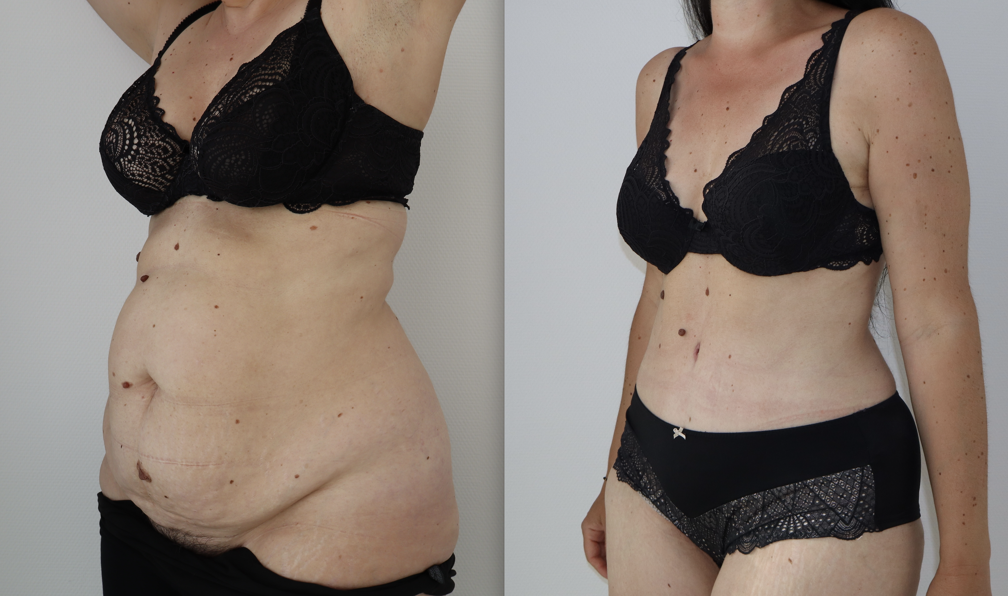 Avant/Après abdominoplastie