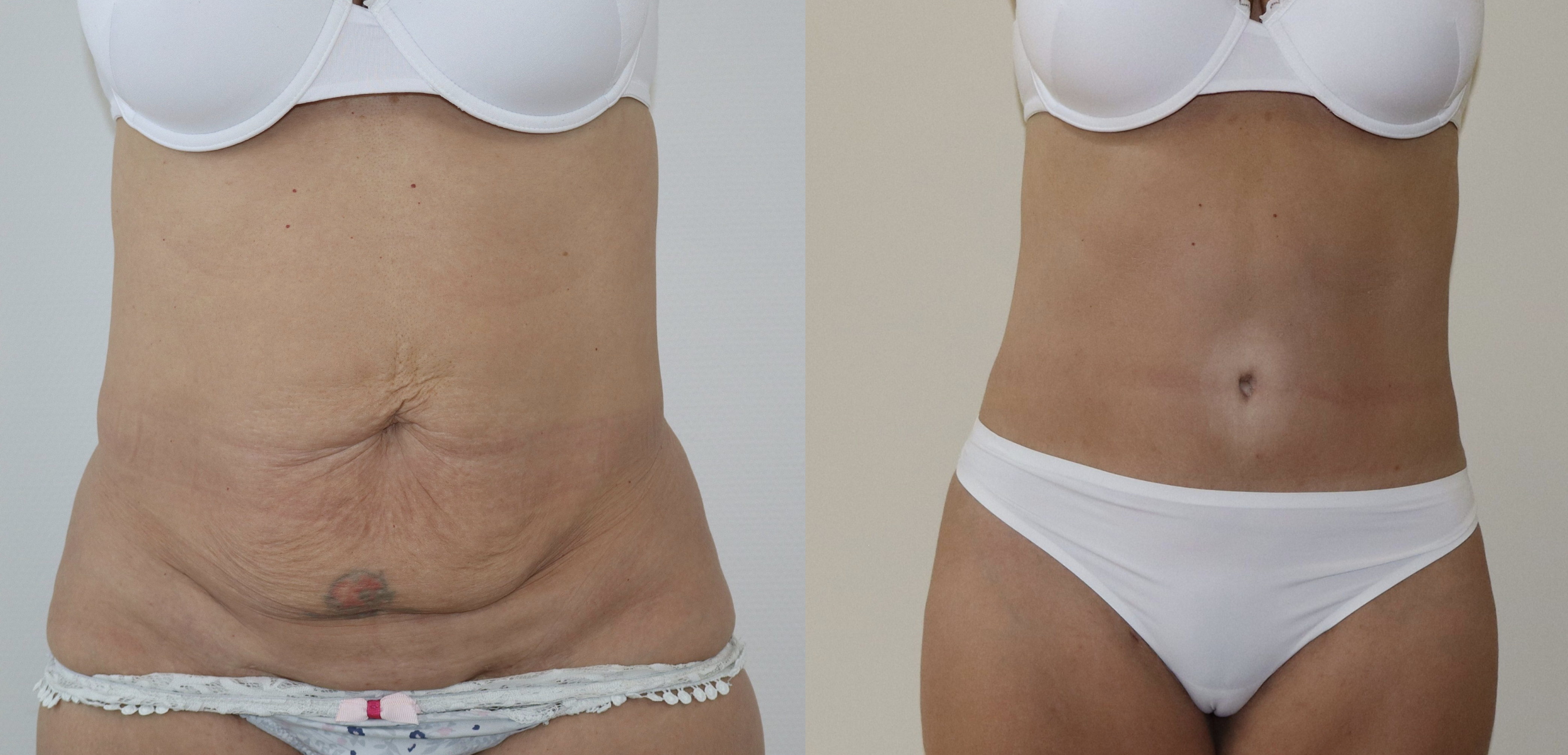 Avant/Après abdominoplastie