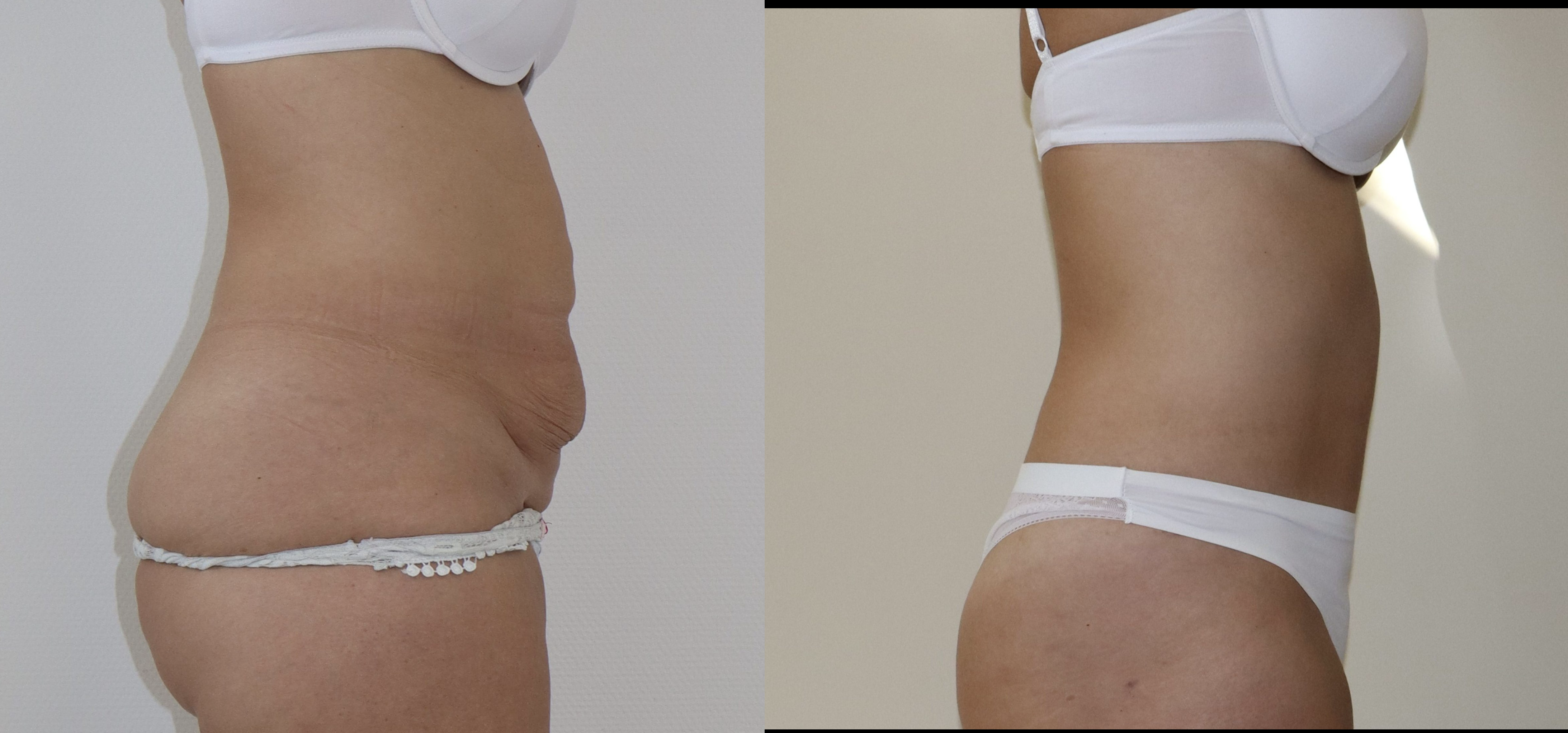 Avant/Après abdominoplastie