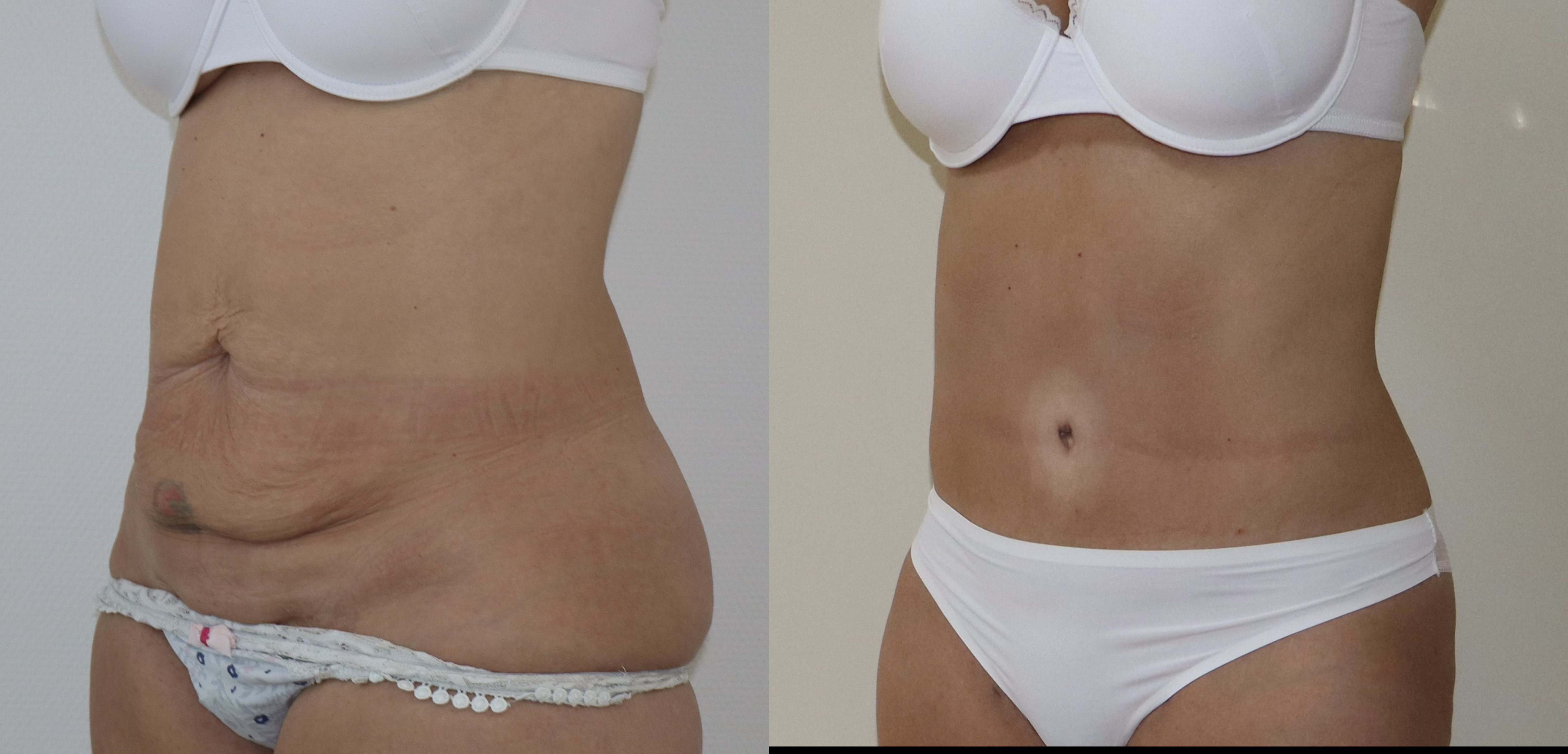 Avant/Après abdominoplastie