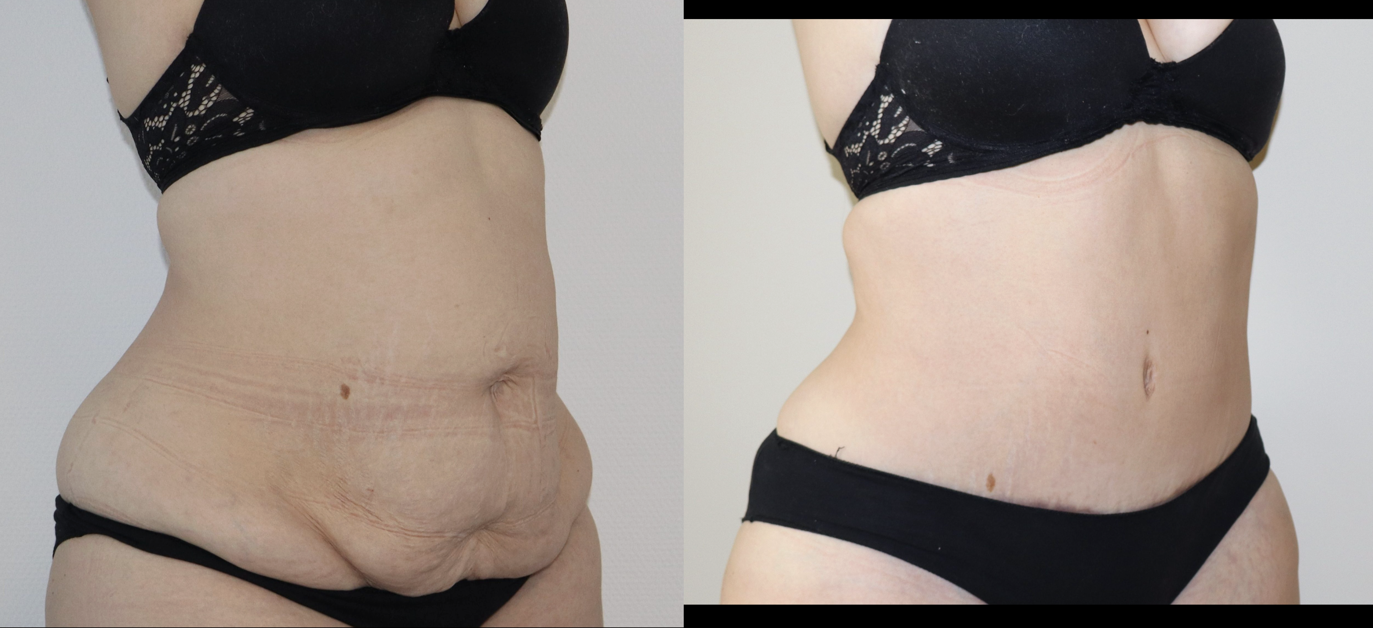 Avant/Après abdominoplastie