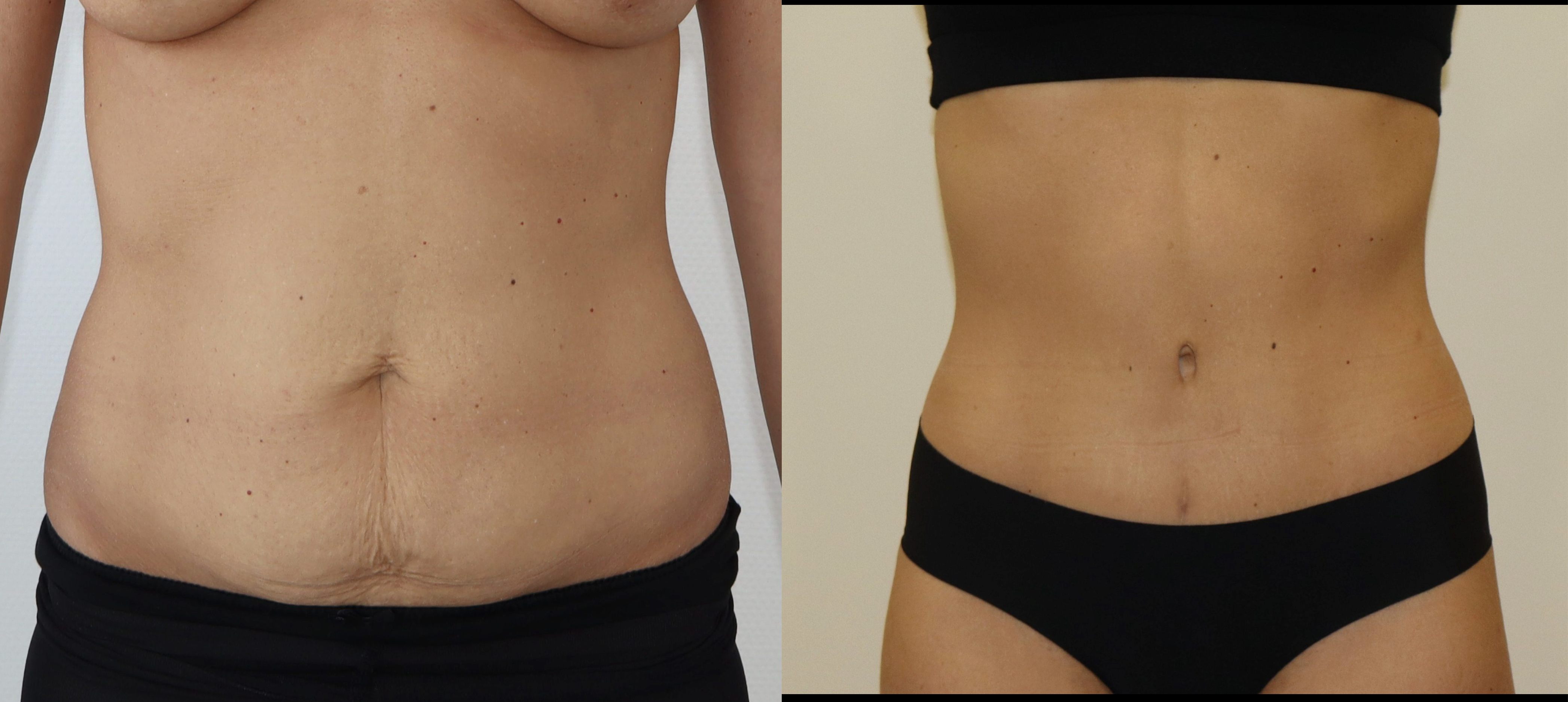 Avant/Après abdominoplastie