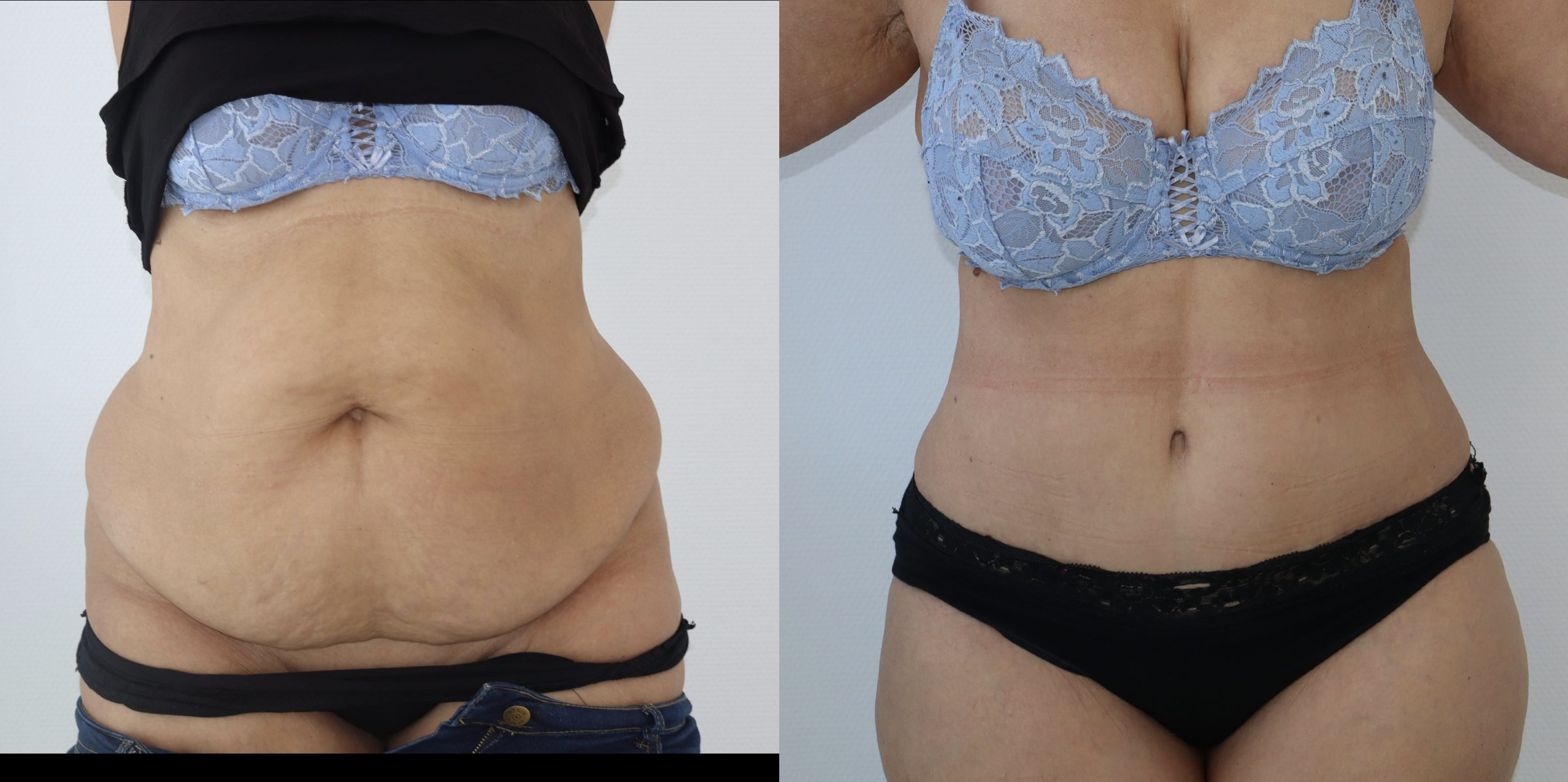 Avant/Après abdominoplastie