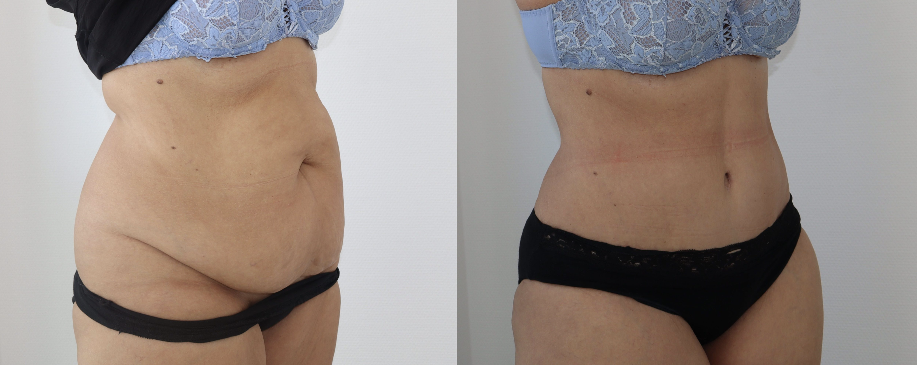 Avant/Après abdominoplastie