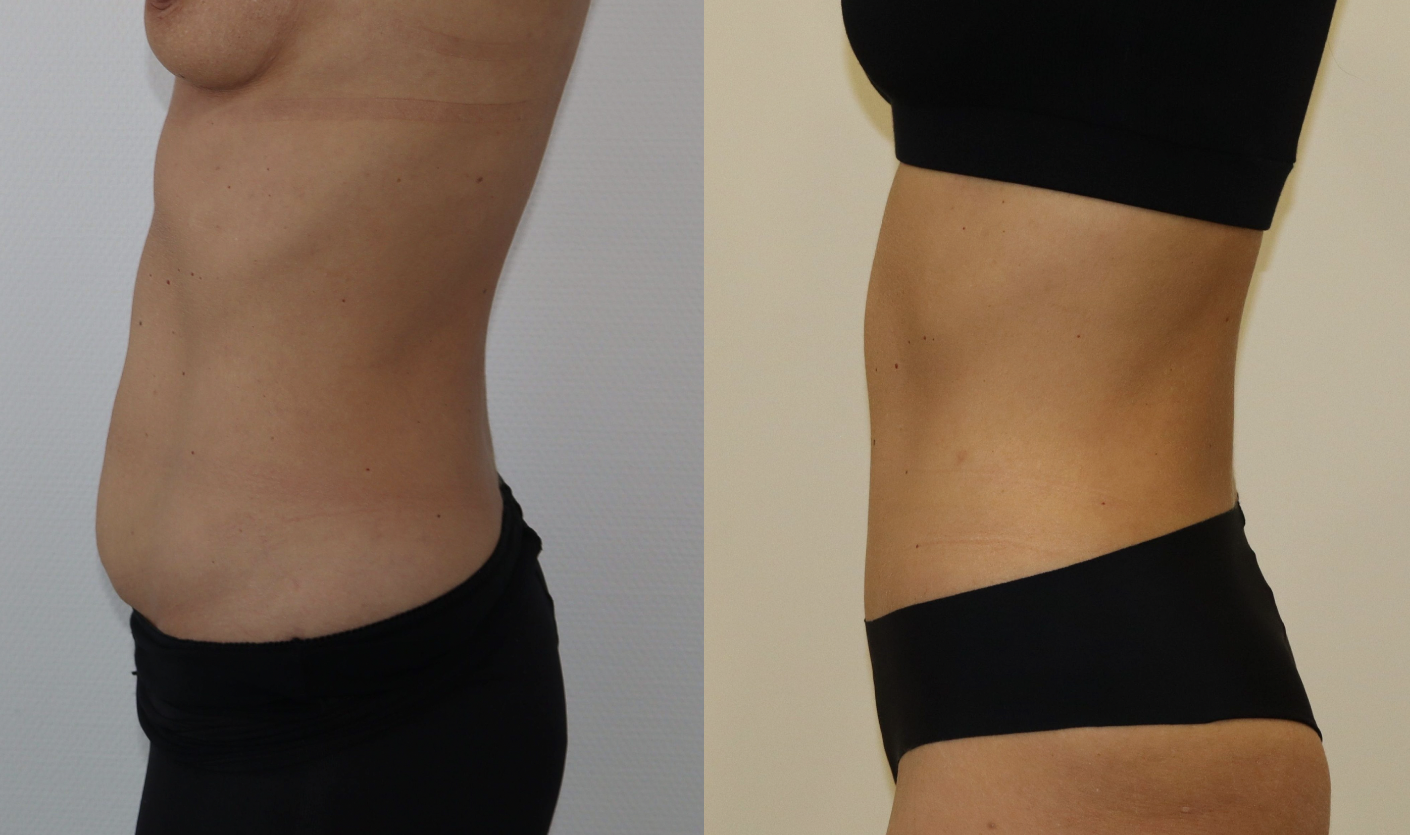 Avant/Après abdominoplastie