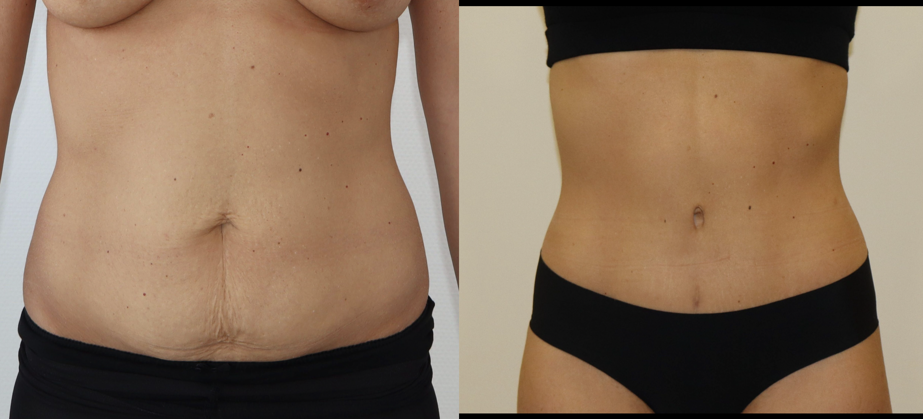 Avant/Après abdominoplastie