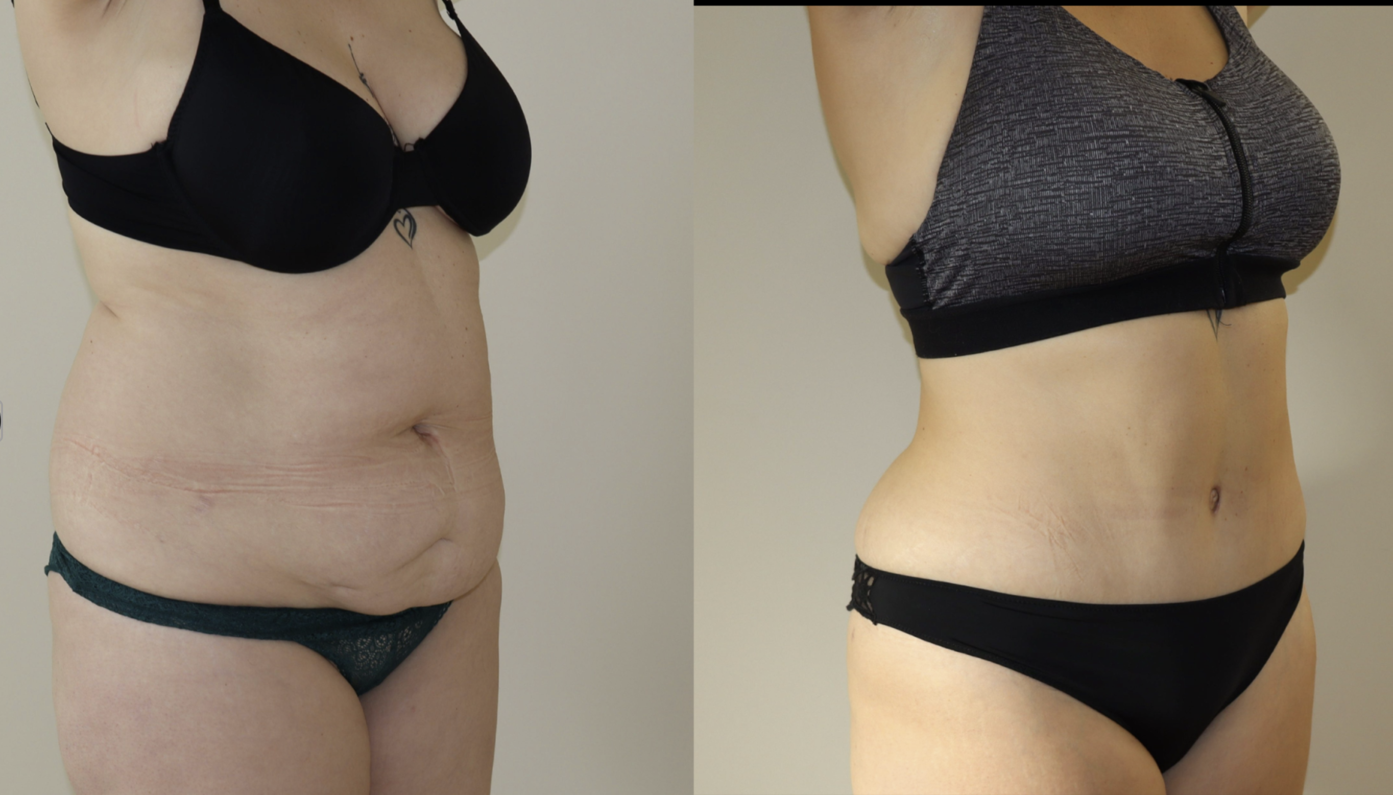 Avant/Après abdominoplastie