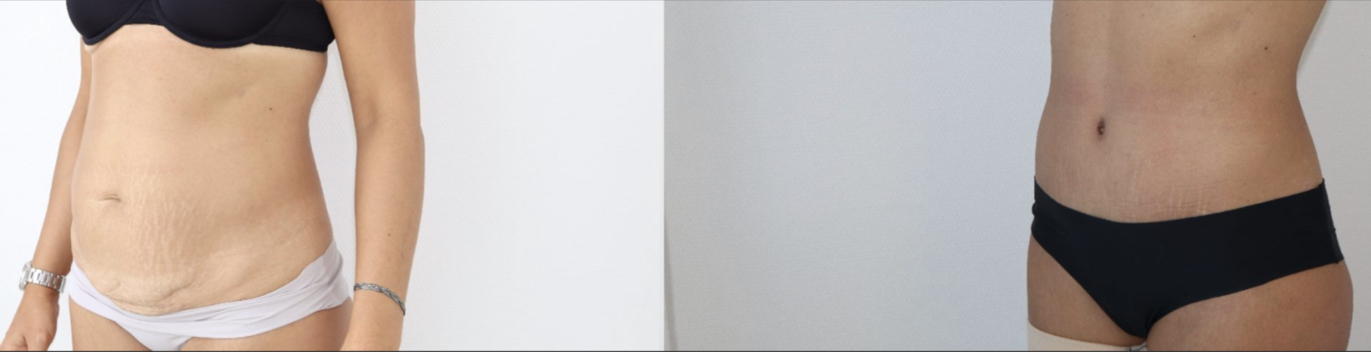 Avant/Après abdominoplastie