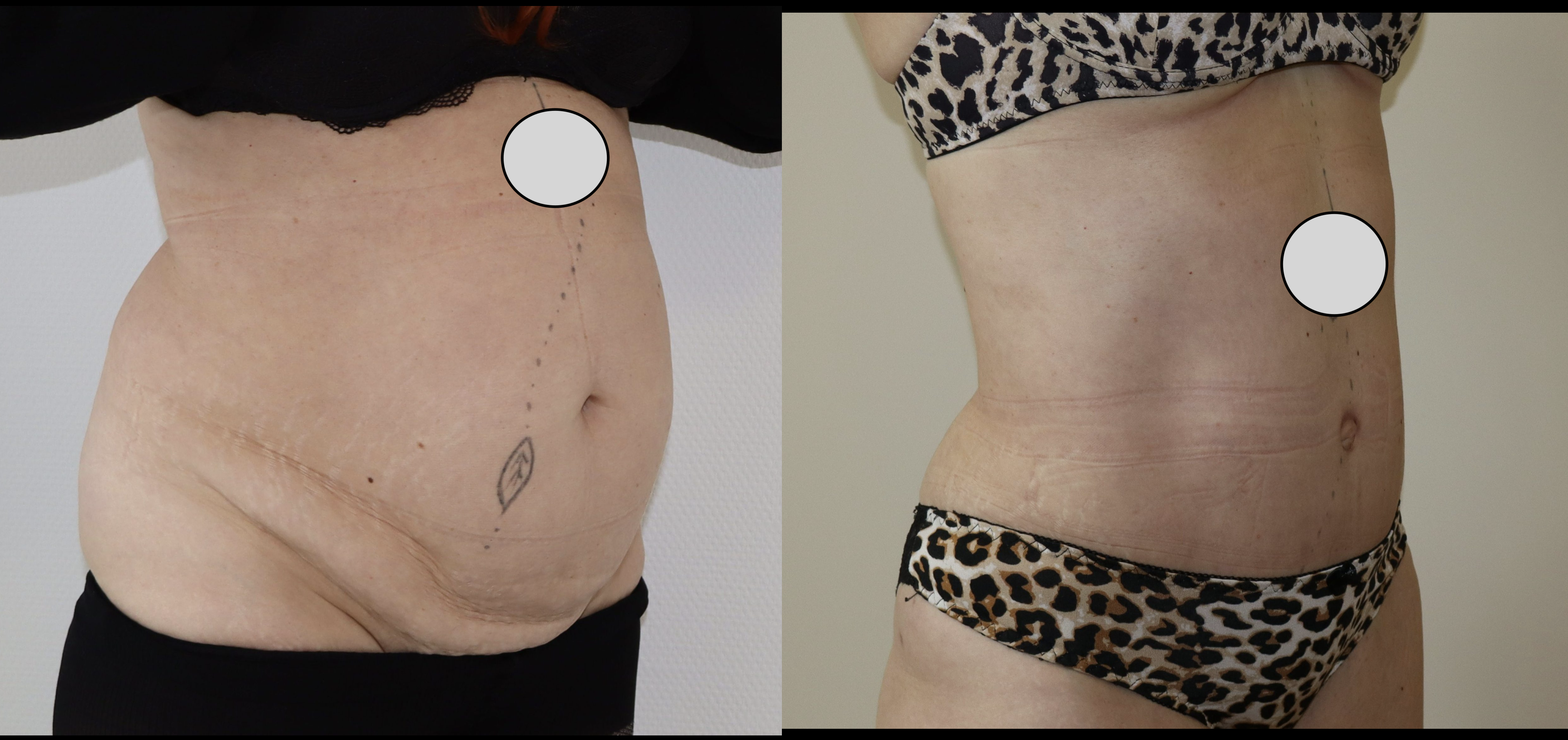 Avant/Après diastasis