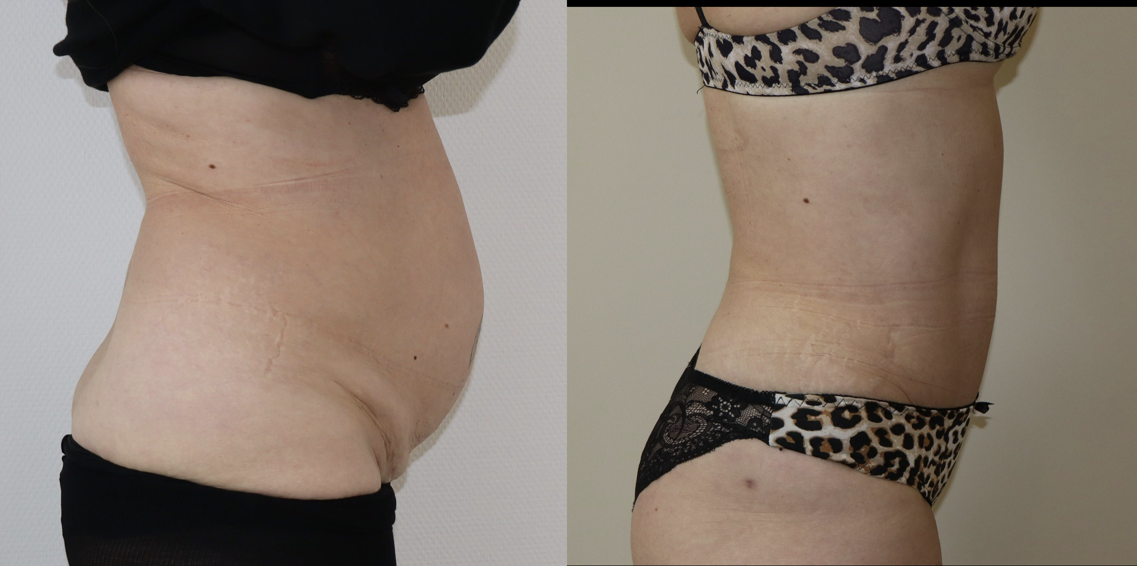 Avant/Après diastasis