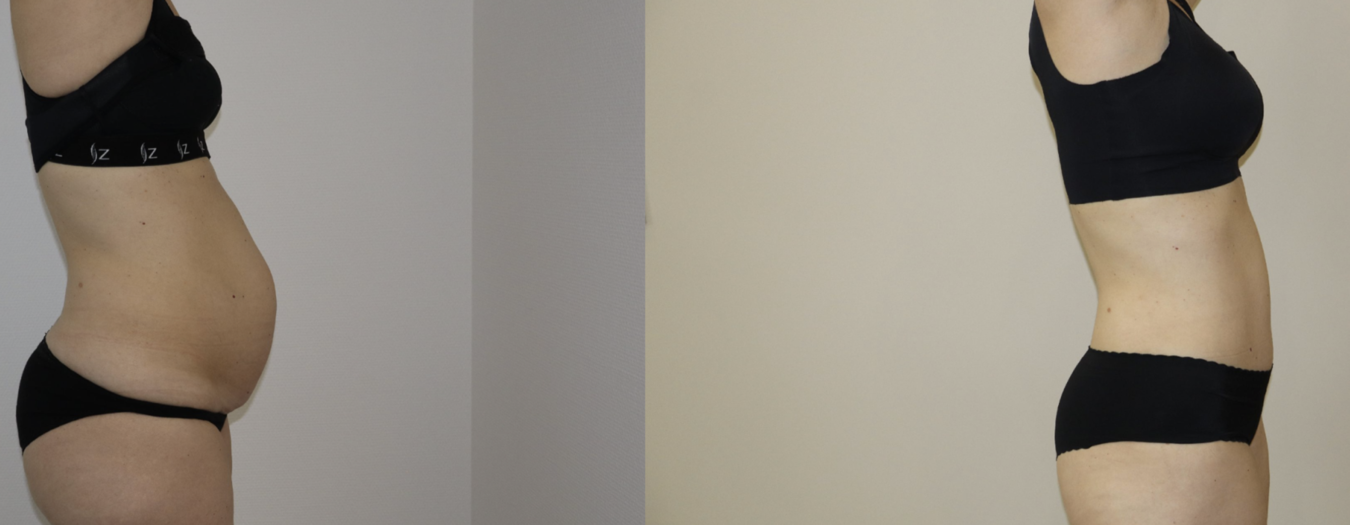 Avant/Après diastasis