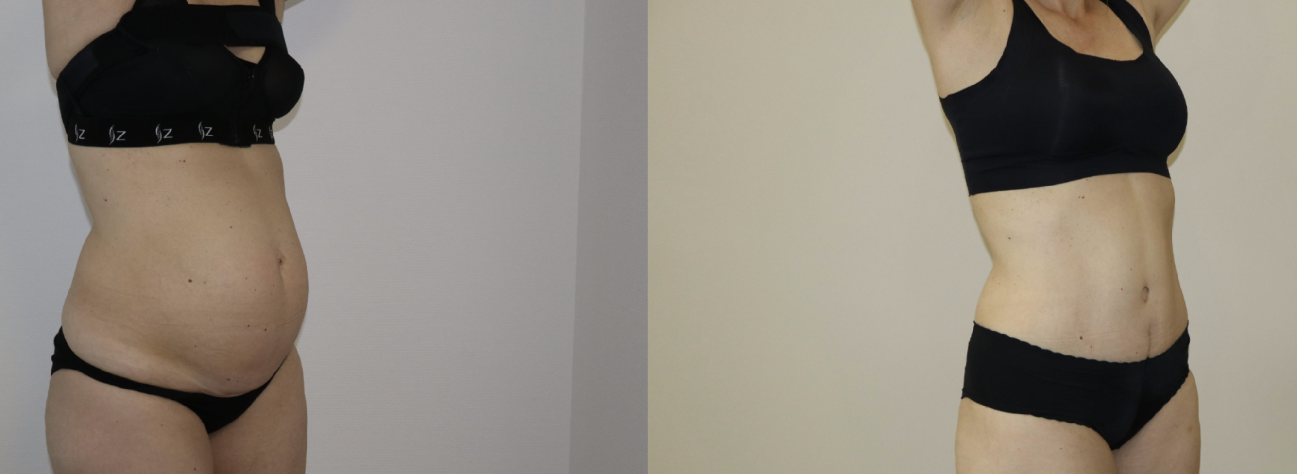 Avant/Après diastasis